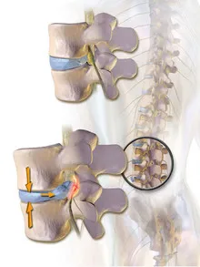 MID ROBO MAX, Spine Decompression Therapy, Chiropractor, Spine, Back bone, Spine solution