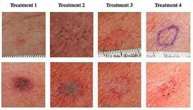 nevus of ota removsl laser tattoo removal machine price buy nevus of ota removsl laser tattoo removal machine price buy