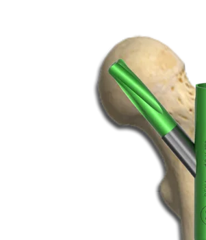Helical Blade Femur Nail - Buy Interlocking Nail Femur,Fracture Nail