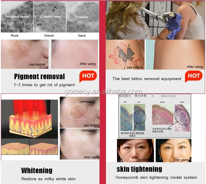 hot-sale-professional-picolaser-picosecond-cynosure-laser-fda-q-switched-nd-yag-laser-tattoo-removal-machine.jpg