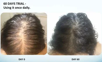 Follistem Stem Cell Hair Regrowth Clinically Proven Buy Stem