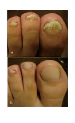 HNC factory finger nail treatment Onychomycosis device