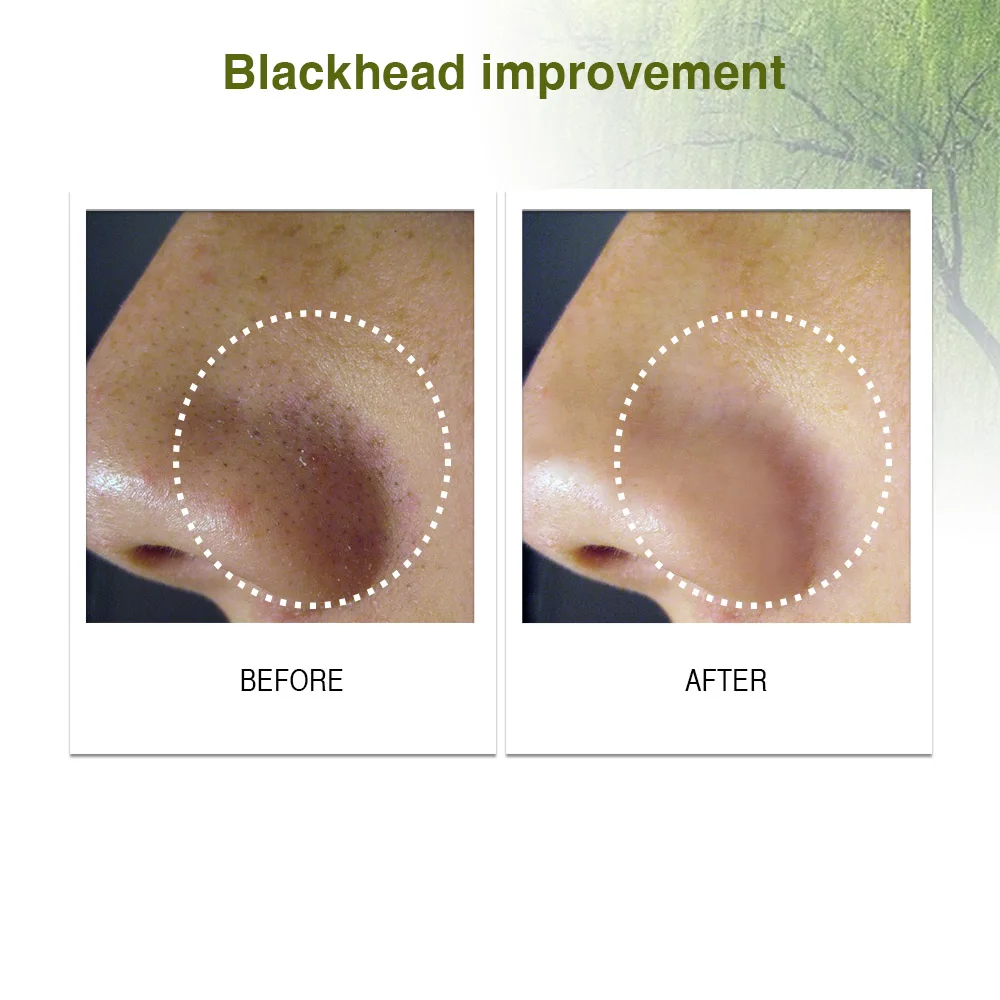 Albums 94+ Pictures Will A Chemical Peel Remove Blackheads Latest