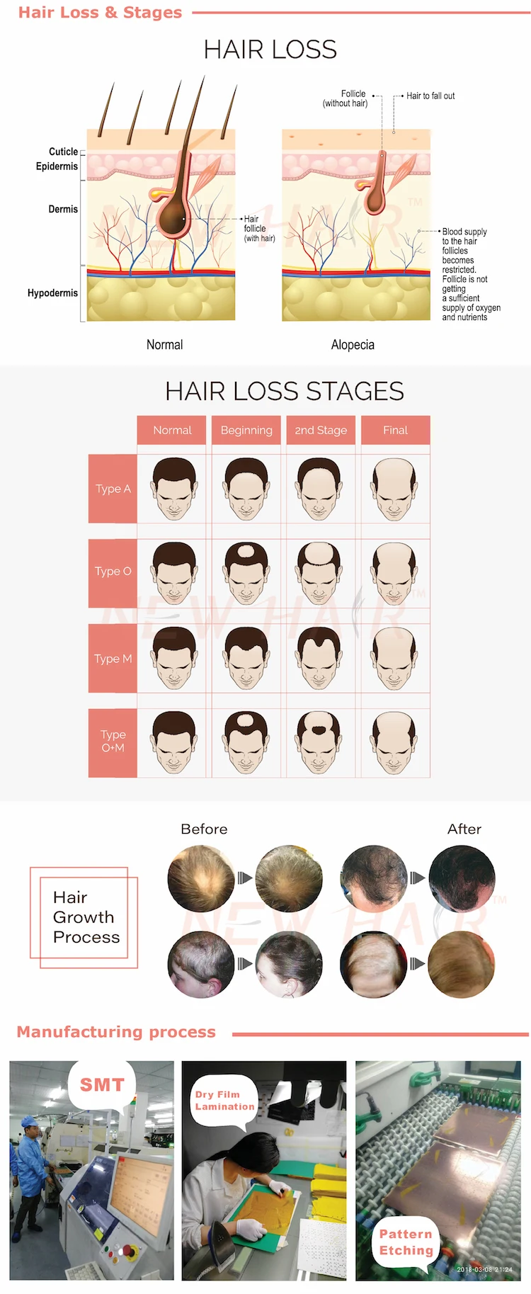 Hair Loss & Stage-TM