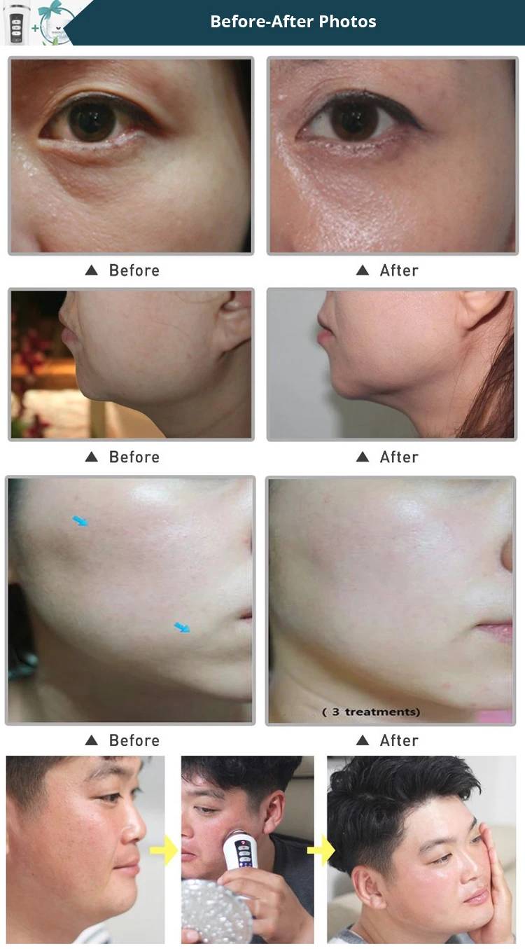 skin tightening cream before and after