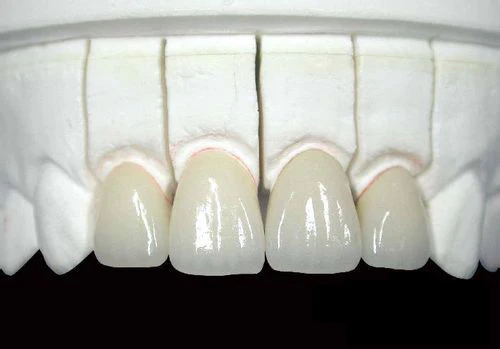Безметалловая керамика на передние зубы фото