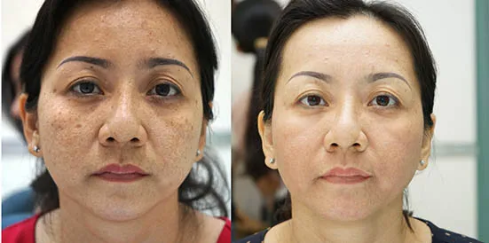 Anti Falten Nutriwhite Melasma Hautcreme Buy Melasma Haut Nutriwhite Melasma Creme Product On Alibaba Com