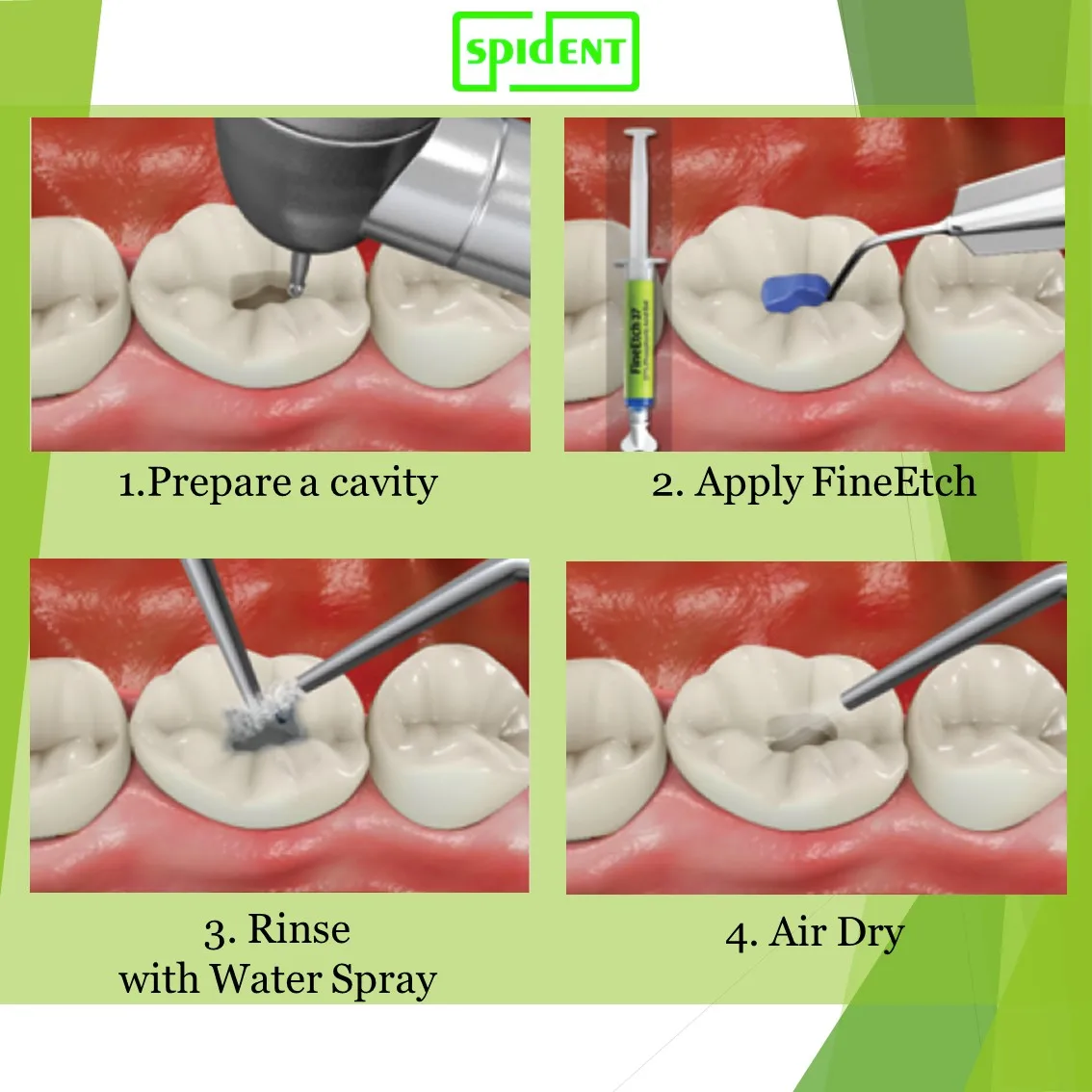 Dental Etching Agent With 37 Phosphoric Acid Buy Dental Etchant