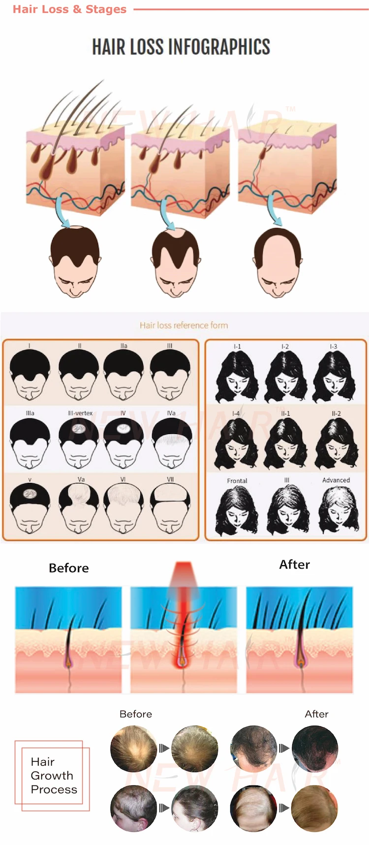 Hair Loss & Stage- TM-2