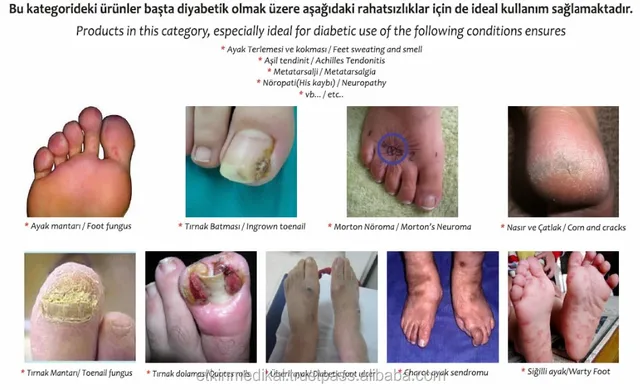 diabetes neuroma diabetes neuroma