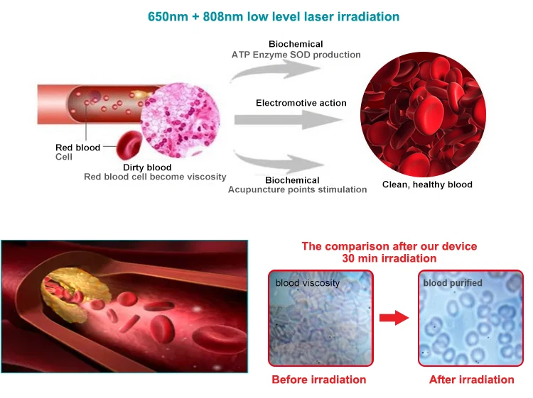 Exclusive private mold 650nm+808nm red light wrist type laser watch  for pain relief  rhinitis  hypertension sugar diabets